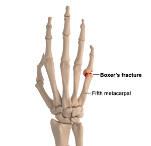 Boxers Fracture Key Biscayne Coral Gables Wrist Specialist Miami Fl