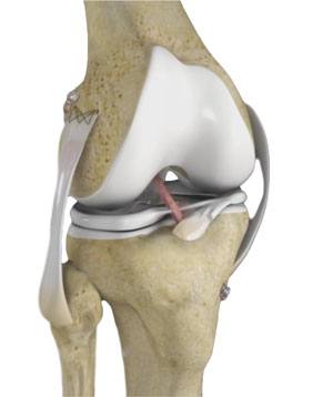 multi-ligament-knee-reconstruction